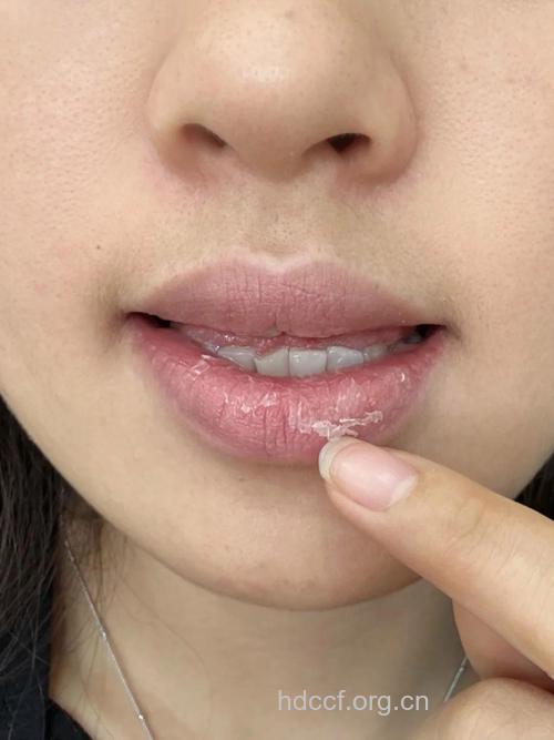 嘴唇一到冬天就起皮 原因都在这里了