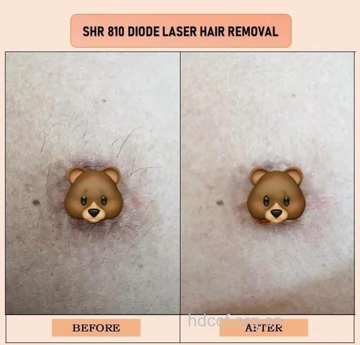 乳晕长毛怎么办 试试乳晕脱毛手术