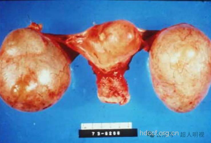 卵巢上皮性肿瘤有什么特点