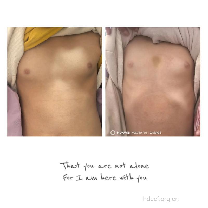 乳房发育不良有两大典型症状