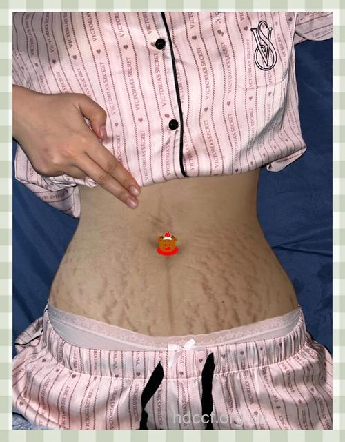 肚皮成“西瓜皮” 去妊娠纹有妙招