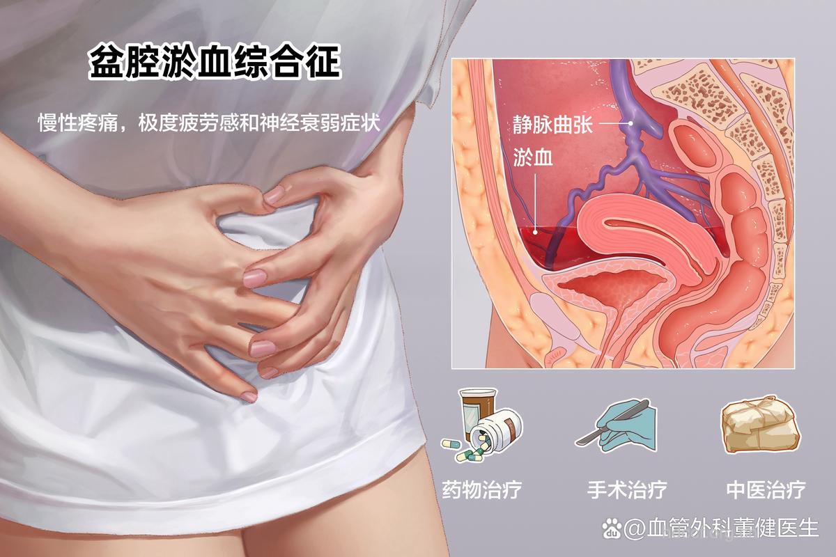 盆腔瘀血症有哪些表现症状