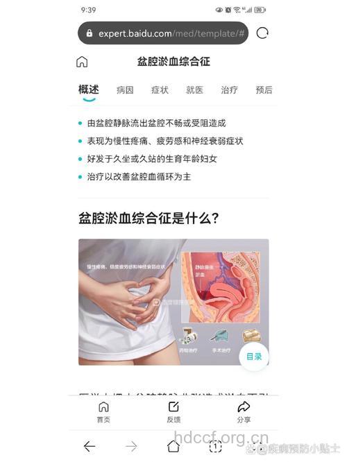 盆腔瘀血症的治疗方法