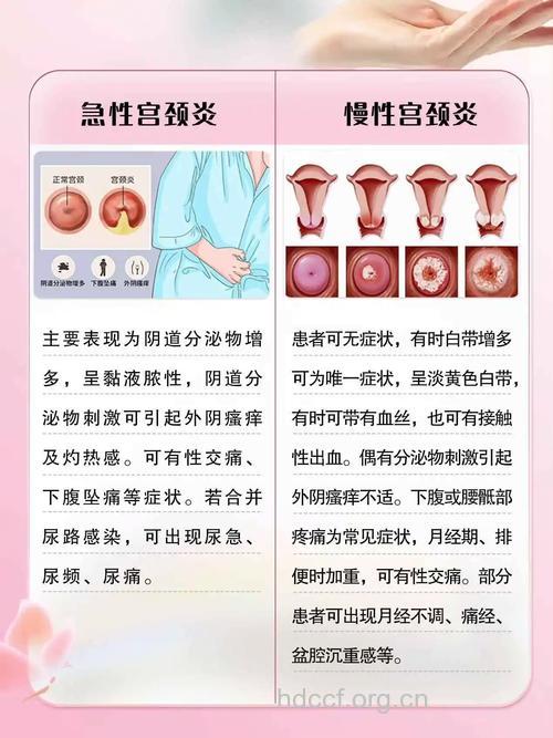 当心慢性宫颈炎致不孕