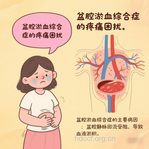 盆腔瘀血症的临床表现症状