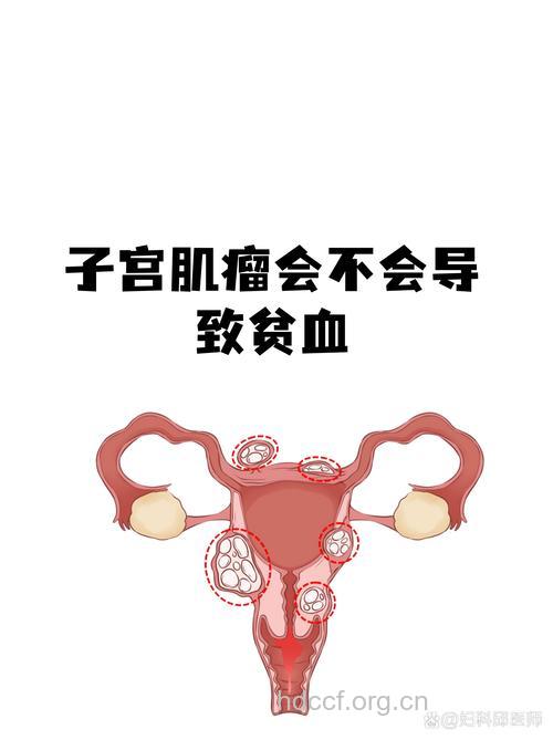 贫血可能是子宫肌瘤作怪