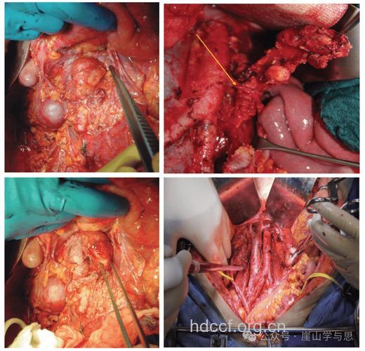 淋巴结切除可治疗卵巢癌
