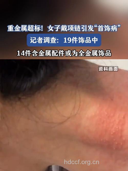 戴首饰有哪些并发症