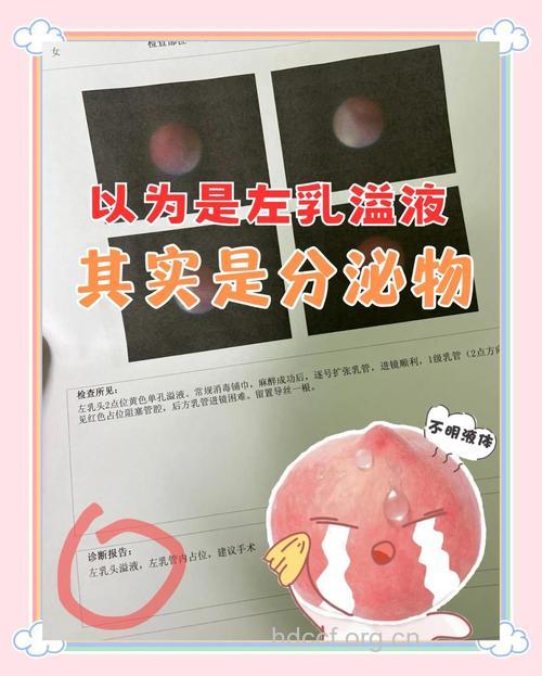 乳头溢液的真假性