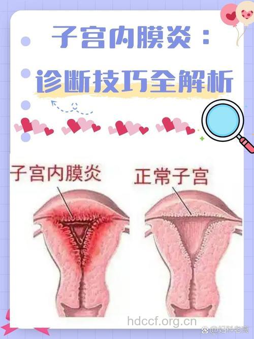 子宫内膜炎有哪些诊断方法