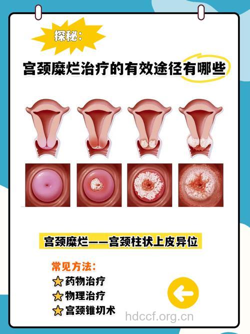 宫颈糜烂需要治疗吗 主要看5个方面