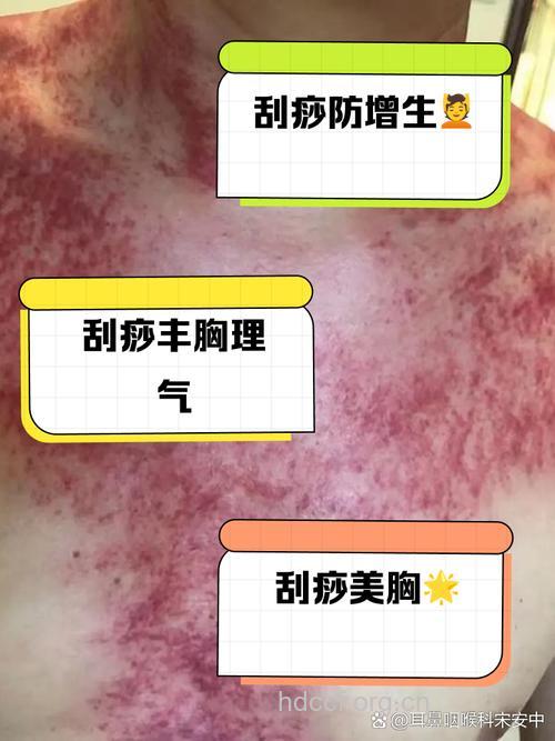 刮痧能治乳腺增生吗