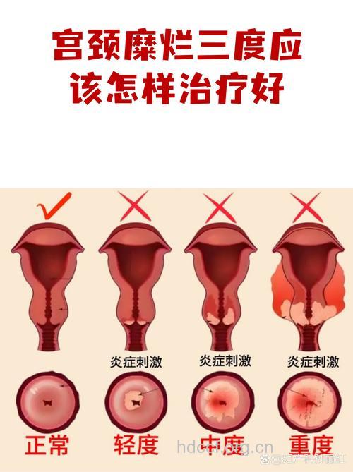 女性宫颈糜烂3度需要手术治疗吗