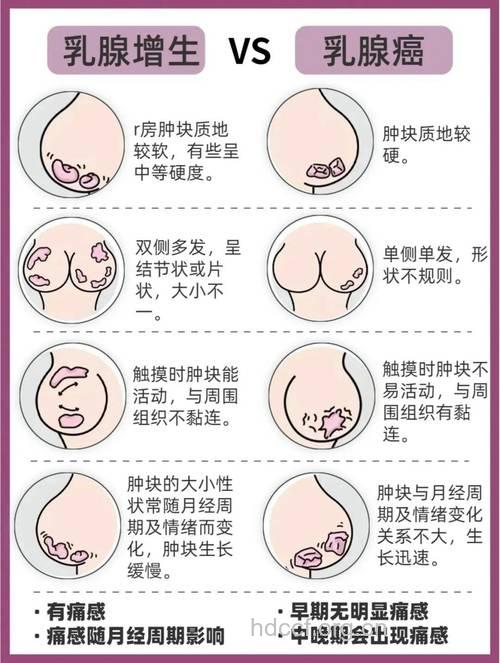 乳腺增生早期的症状