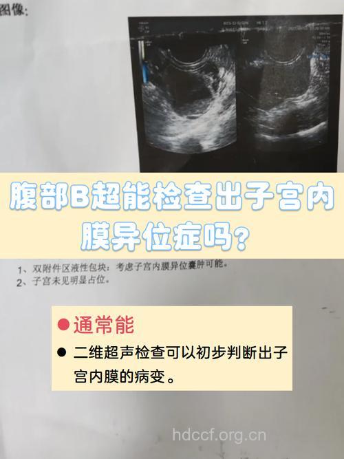 子宫内膜异位症怎么检查出来 推荐这几种