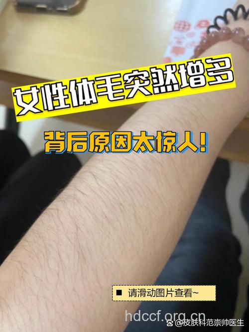 女人汗毛多是什么原因