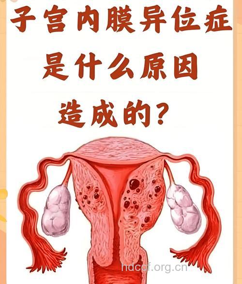 子宫内膜异位症的6种表现症状