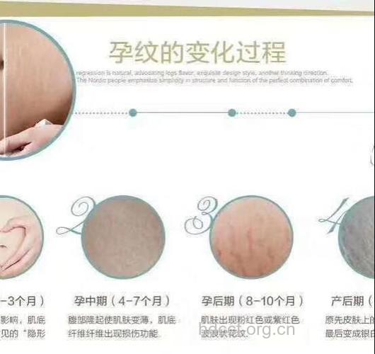 妊娠纹的形成原因 吃猪蹄防妊娠纹吗