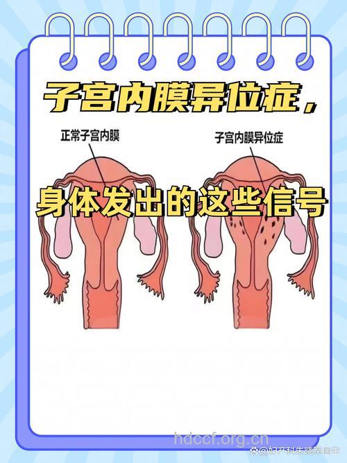 子宫内膜异位症有什么症状