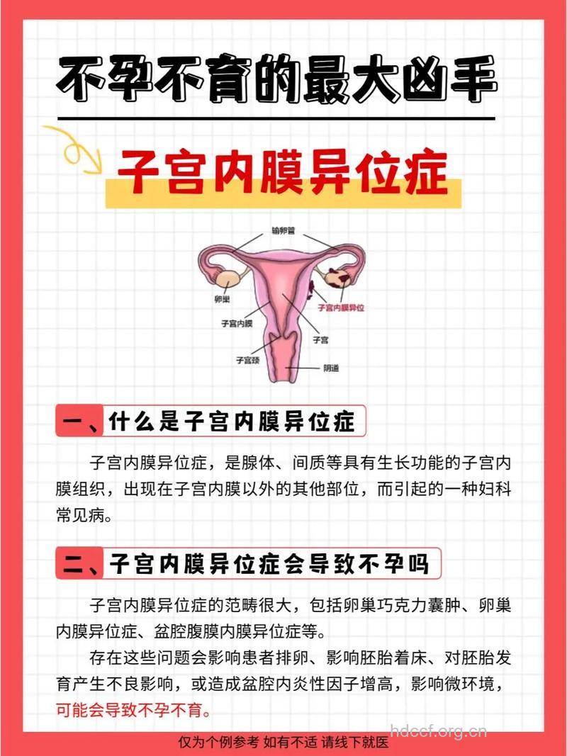 为什么会导致子宫内膜异位症