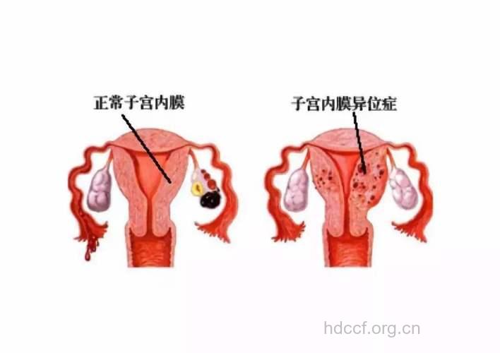 子宫内膜异位