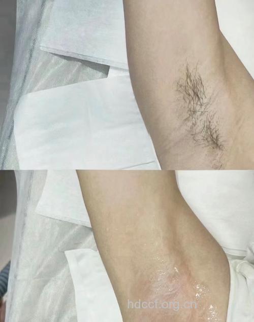 女性刮腋毛会导致乳腺癌？