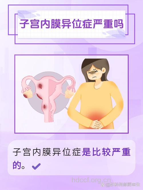 子宫内膜异位症会致癌吗