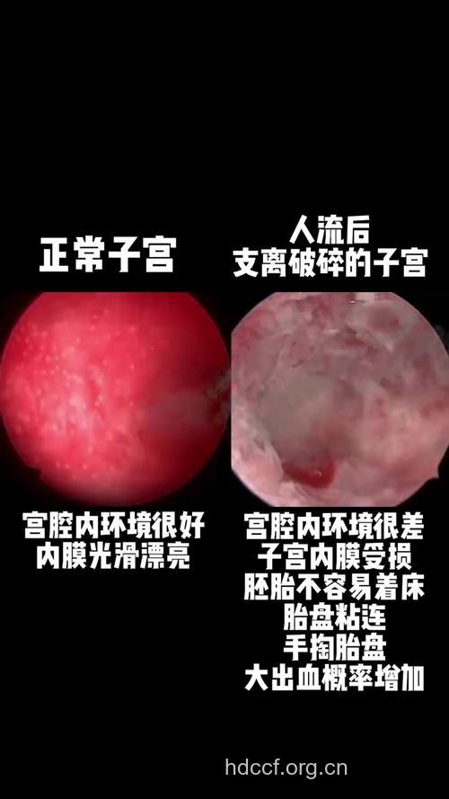 人流致子宫内膜?