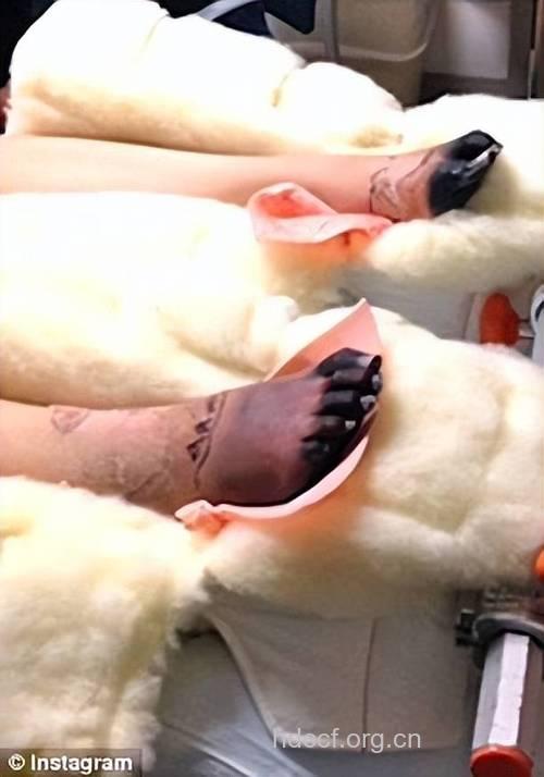 卫生棉条使用不当造成的死亡