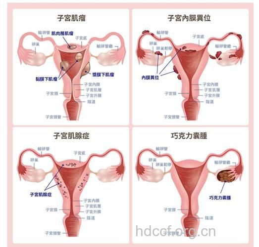 子宫内膜异位症与紧身衣的关系