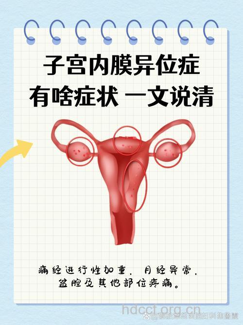 子宫内膜异位症最常见的症状