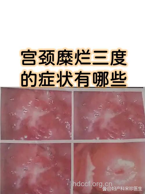 宫颈糜烂主要有什么症状呢