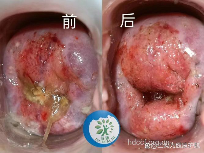 宫颈糜烂复发后有什么症状