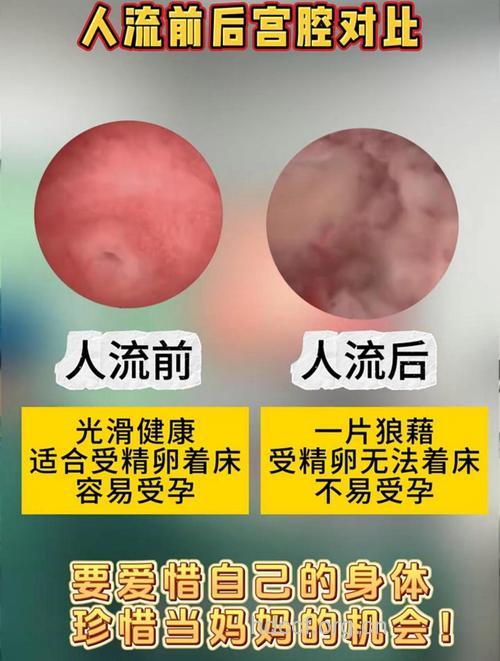 人流后爱一场 盆腔炎成了难言的伤