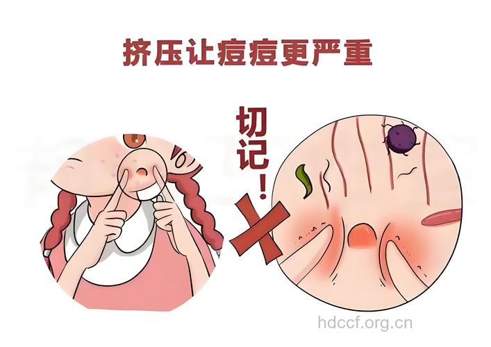 得了青春痘不要用手挤