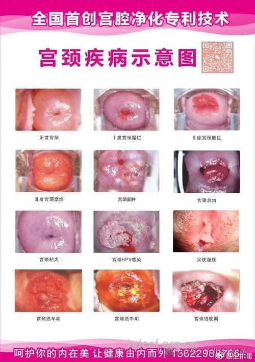 中度宫颈糜烂的症状表现
