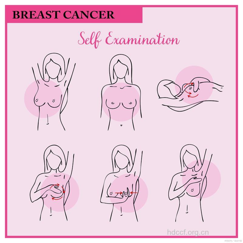 乳腺癌有哪些自查手法