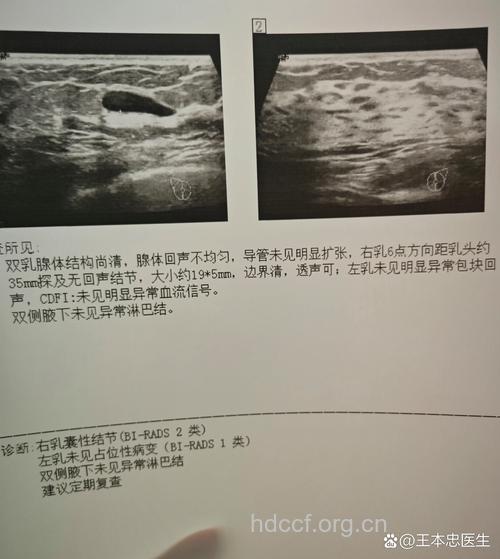 怎么用彩超辨别乳腺囊肿