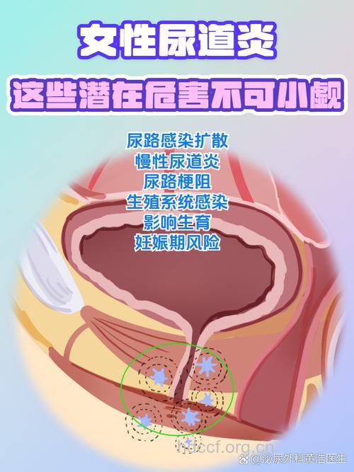女性感染尿道炎的四个高危期