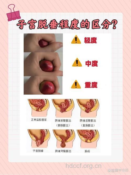 子宫脱垂易与4种疾病混淆 如何鉴别诊断