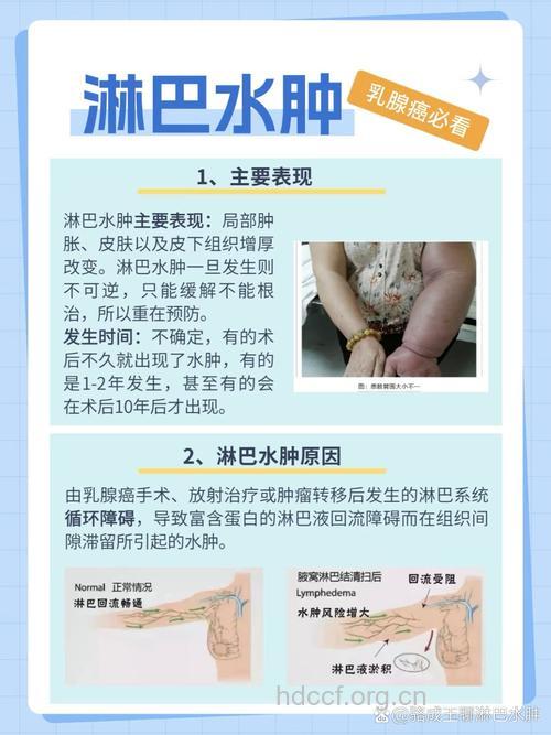 乳腺癌患者淋巴水肿是怎么回事