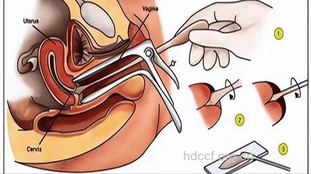 怎样让阴道缩小 缩小阴道的方法推荐