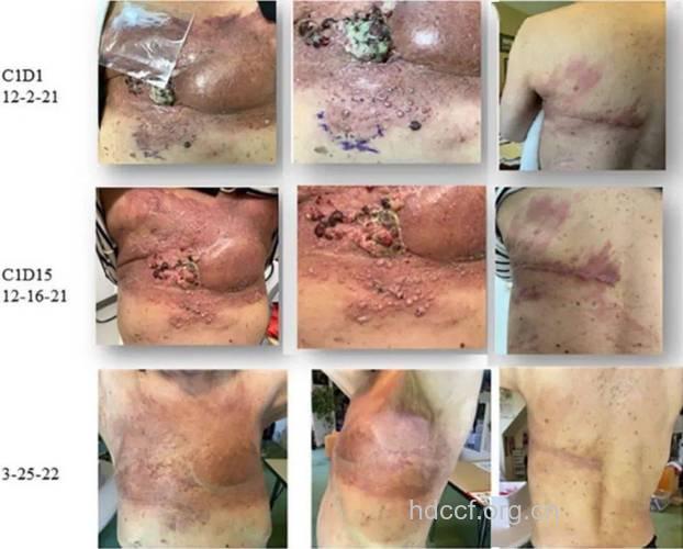 乳腺癌转移有什么症状