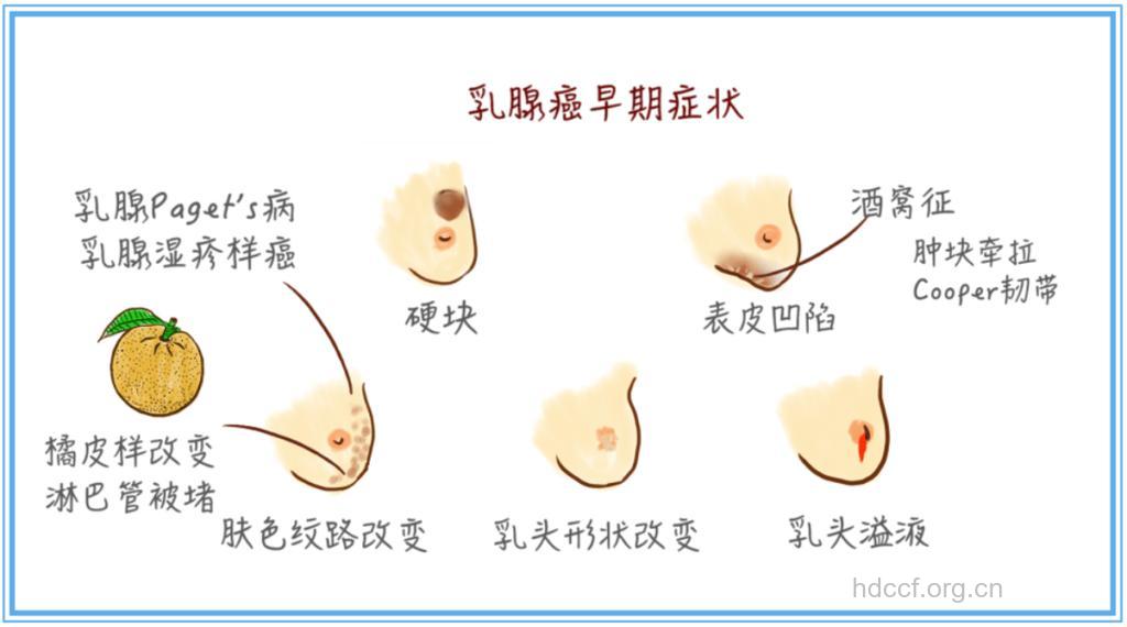 乳腺癌的早期信号是什么