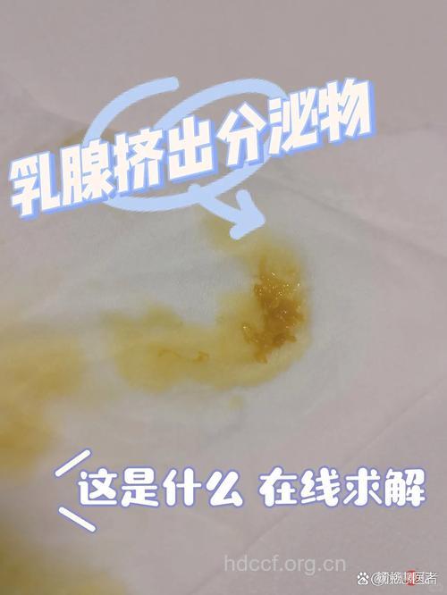 出现乳头溢液是得了乳腺癌吗