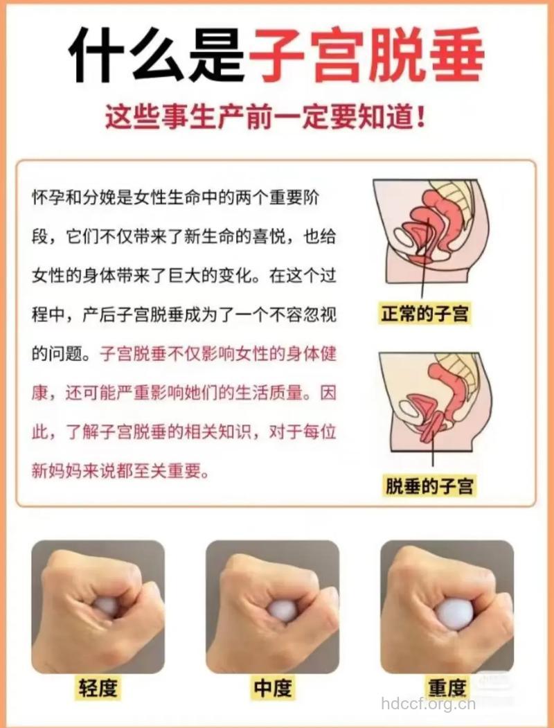 子宫脱垂的护理方法