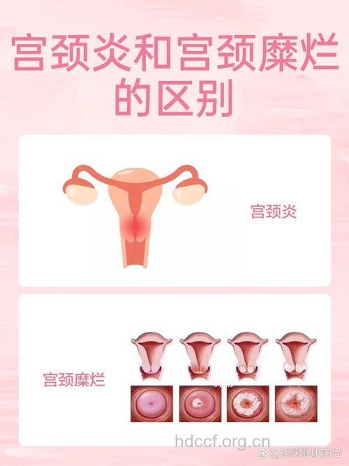 宫颈糜烂和宫颈炎有什么关联