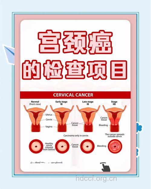 30岁的女人要防五种癌 防癌检查有哪些