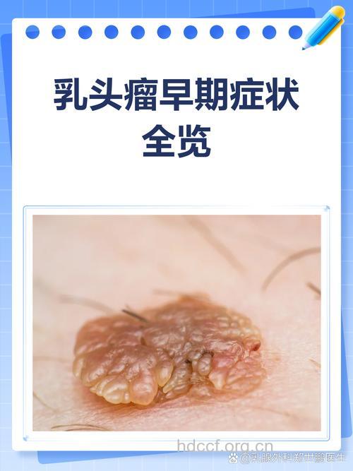 女性乳头变色是乳腺癌早期症状