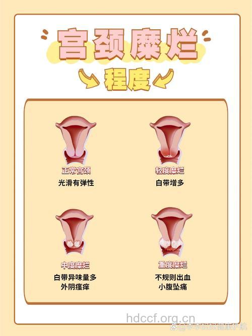 宫颈糜烂有什么防治原则